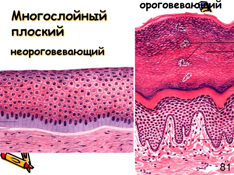 Многослойный плоский  неороговевающий ороговевающий 81